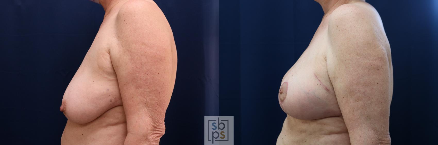 Before & After Breast Reconstruction Case 654 Left Side View in Torrance & Los Angeles, CA, CA