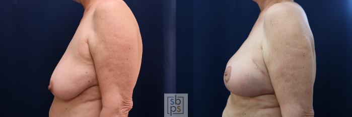 Before & After Breast Reconstruction Case 654 Left Side View in Torrance, CA