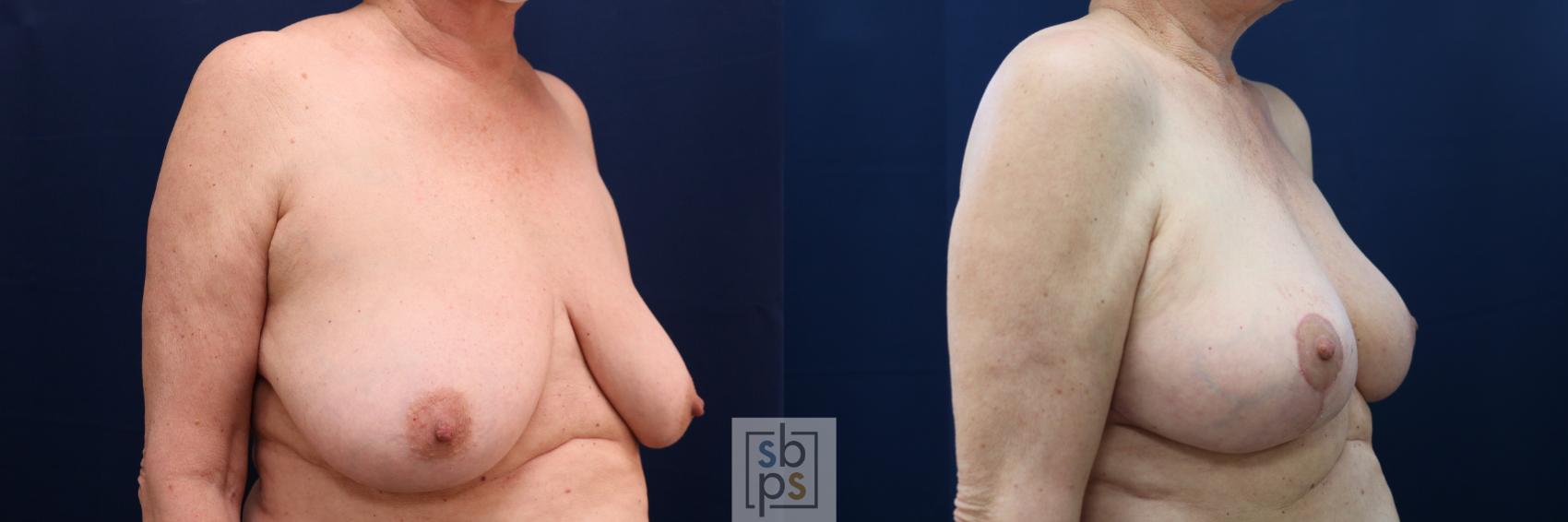Before & After Breast Reconstruction Case 654 Right Oblique View in Torrance & Los Angeles, CA, CA