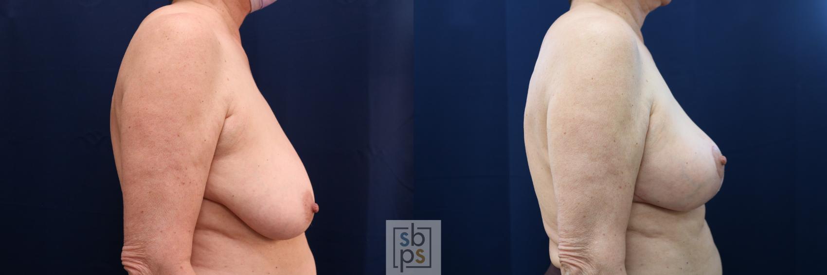 Before & After Breast Reconstruction Case 654 Right Side View in Torrance & Los Angeles, CA, CA