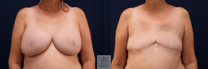 Before & After Breast Reconstruction Case 668 Front View in Torrance, CA