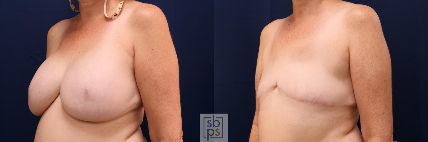 Before & After Breast Reconstruction Case 668 Left Oblique View in Torrance & Los Angeles, CA, CA