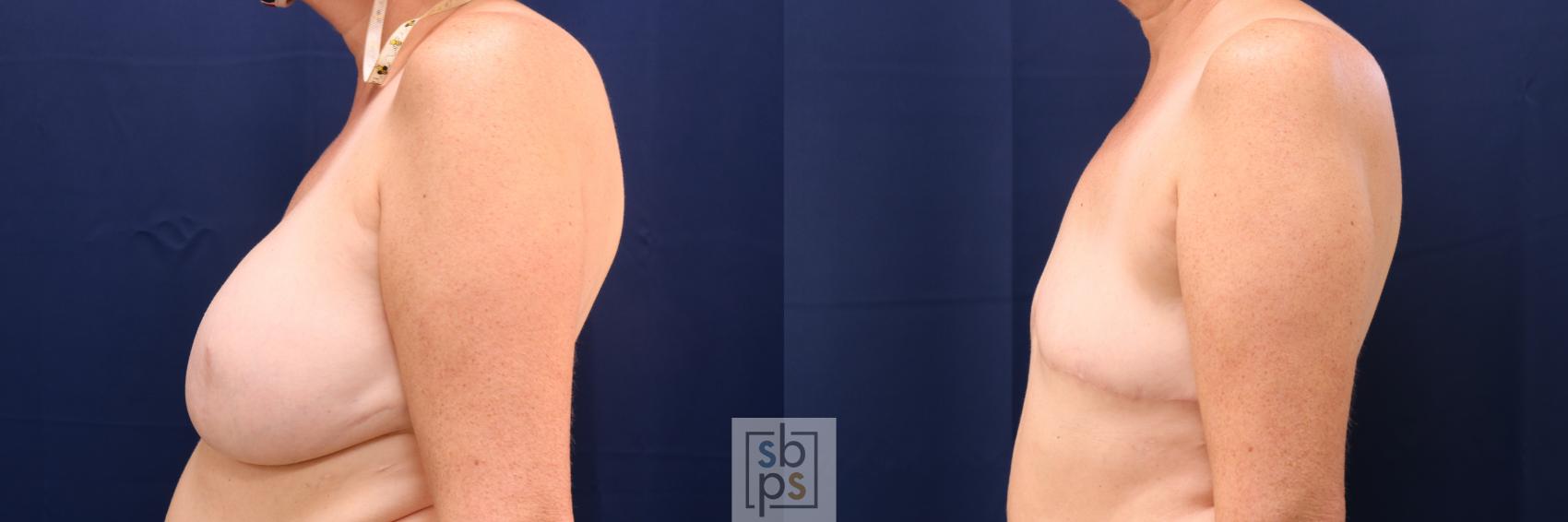Before & After Breast Reconstruction Case 668 Left Side View in Torrance & Los Angeles, CA, CA