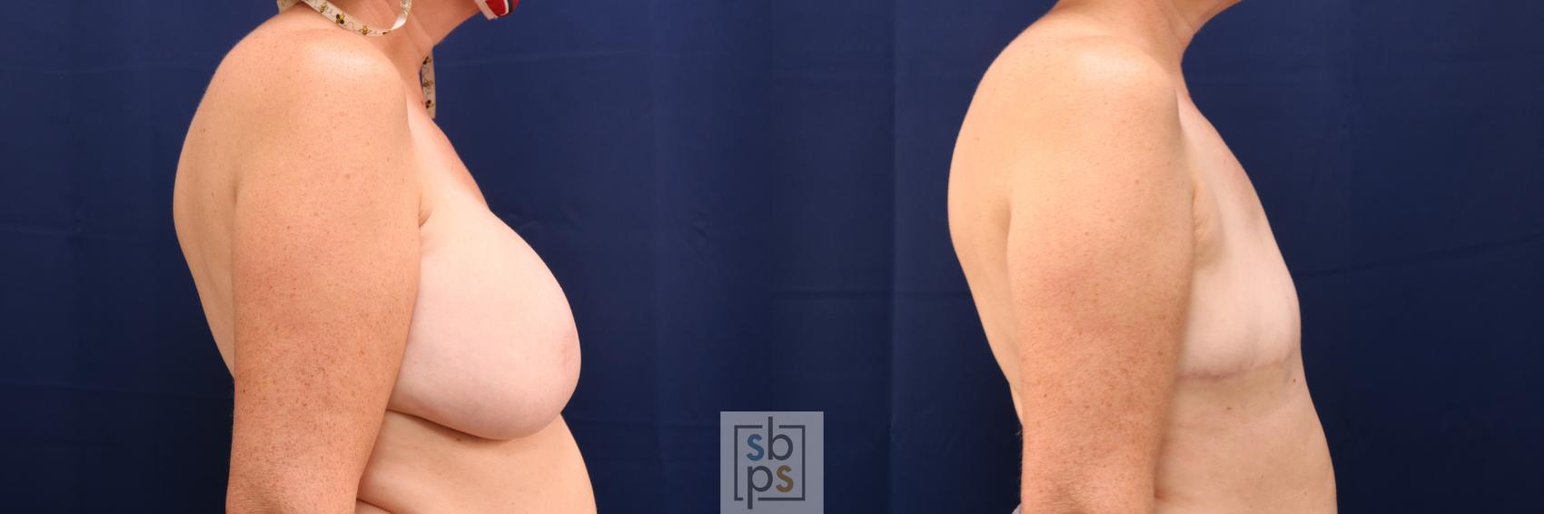 Before & After Breast Reconstruction Case 668 Right Side View in Torrance & Los Angeles, CA, CA