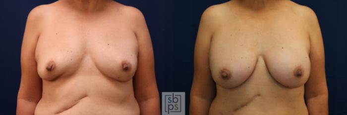Before & After Breast Reconstruction Case 669 Front View in Torrance, CA