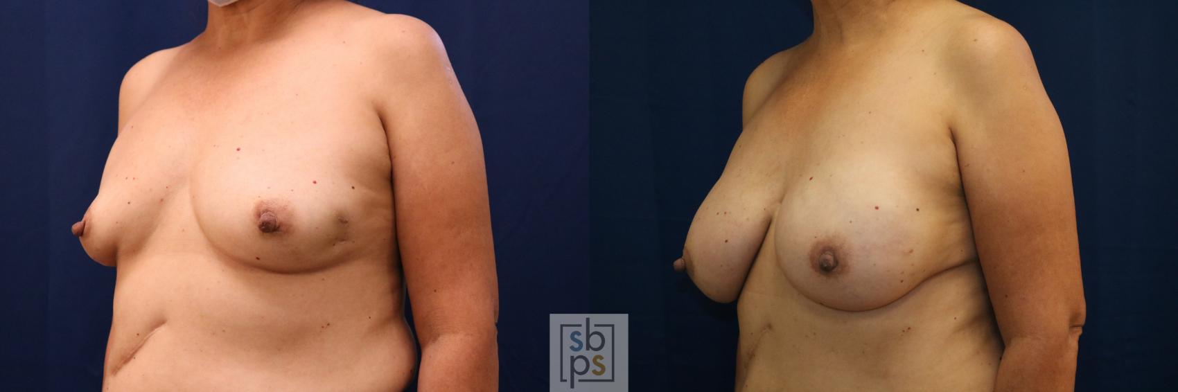 Before & After Breast Reconstruction Case 669 Left Oblique View in Torrance & Los Angeles, CA, CA