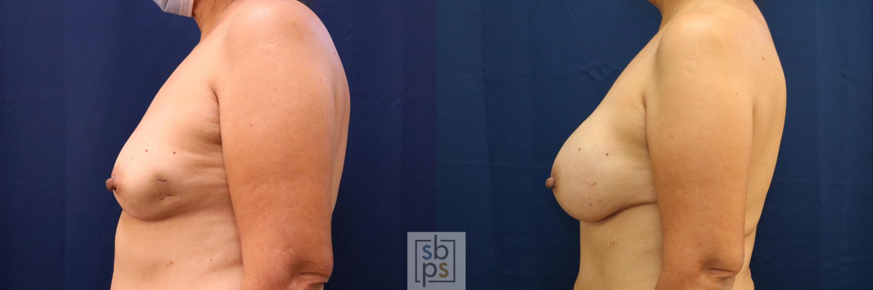 Before & After Breast Reconstruction Case 669 Left Side View in Torrance & Los Angeles, CA, CA