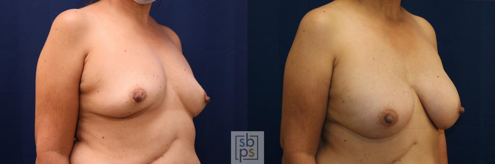Before & After Breast Reconstruction Case 669 Right Oblique View in Torrance & Los Angeles, CA, CA