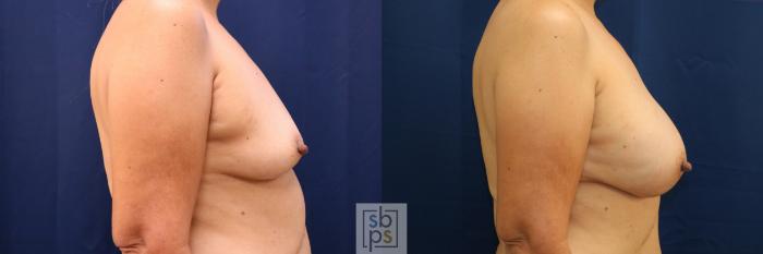 Before & After Breast Reconstruction Case 669 Right Side View in Torrance, CA
