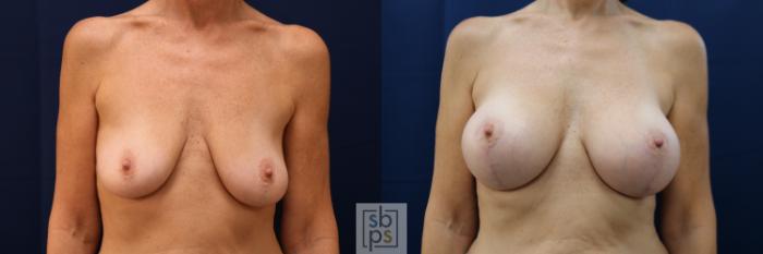 Before & After Breast Reconstruction Case 686 Front View in Torrance, CA