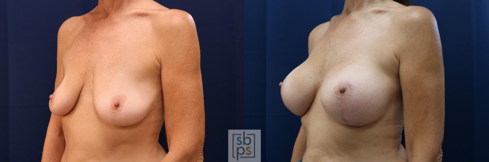 Before & After Breast Reconstruction Case 686 Left Oblique View in Torrance & Los Angeles, CA, CA