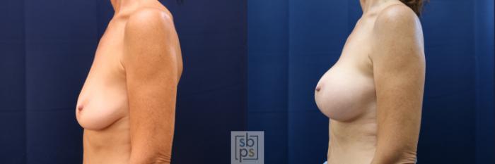 Before & After Breast Reconstruction Case 686 Left Side View in Torrance, CA