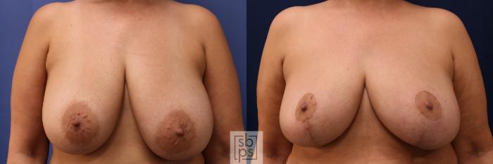 Before & After Breast Reconstruction Case 696 Front View in Los Angeles & Torrance, CA, CA