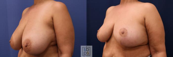 Before & After Breast Reconstruction Case 696 Left Oblique View in Los Angeles & Torrance, CA, CA