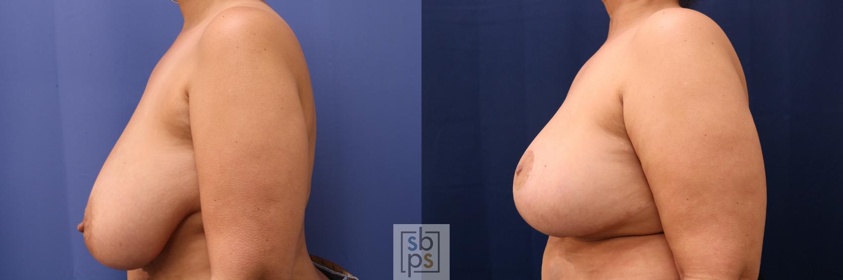 Before & After Breast Reconstruction Case 696 Left Side View in Torrance & Los Angeles, CA, CA