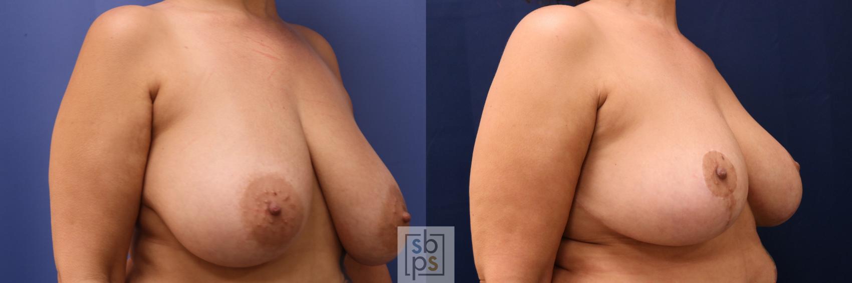 Before & After Breast Reconstruction Case 696 Right Oblique View in Torrance & Los Angeles, CA, CA