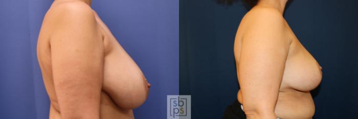 Before & After Breast Reconstruction Case 696 Right Side View in Los Angeles & Torrance, CA, CA