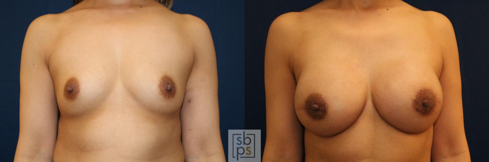 Before & After Breast Reconstruction Case 710 Front View in Los Angeles & Torrance, CA, CA