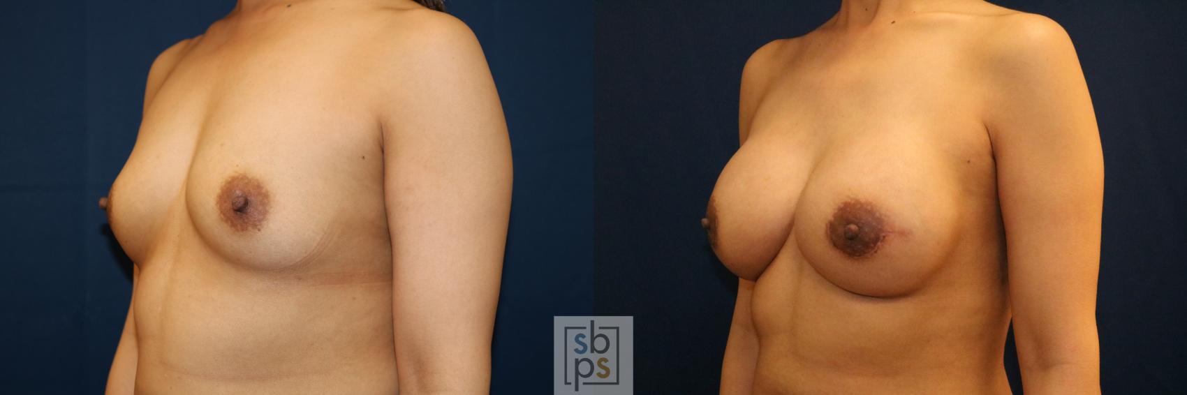 Before & After Breast Reconstruction Case 710 Left Oblique View in Torrance & Los Angeles, CA, CA