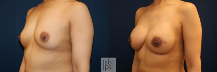 Before & After Breast Reconstruction Case 710 Left Oblique View in Los Angeles & Torrance, CA, CA