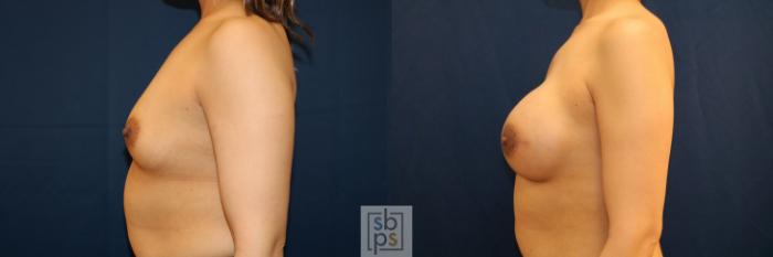 Before & After Breast Reconstruction Case 710 Left Side View in Los Angeles & Torrance, CA, CA