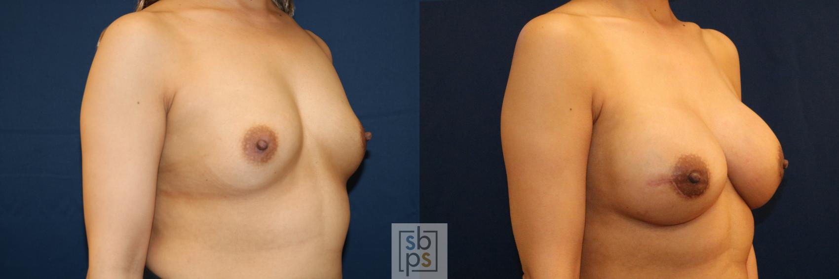 Before & After Breast Reconstruction Case 710 Right Oblique View in Torrance & Los Angeles, CA, CA