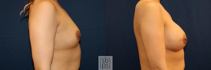 Before & After Breast Reconstruction Case 710 Right Side View in Los Angeles & Torrance, CA, CA