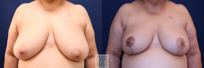 Before & After Breast Reconstruction Case 719 Front View in Los Angeles & Torrance, CA, CA