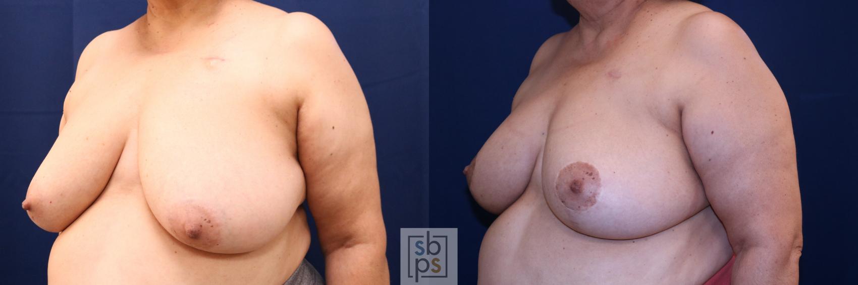 Before & After Breast Reconstruction Case 719 Left Oblique View in Torrance & Los Angeles, CA, CA