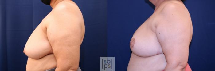 Before & After Breast Reconstruction Case 719 Left Side View in Los Angeles & Torrance, CA, CA