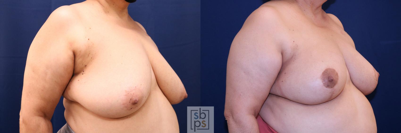 Before & After Breast Reconstruction Case 719 Right Oblique View in Torrance & Los Angeles, CA, CA