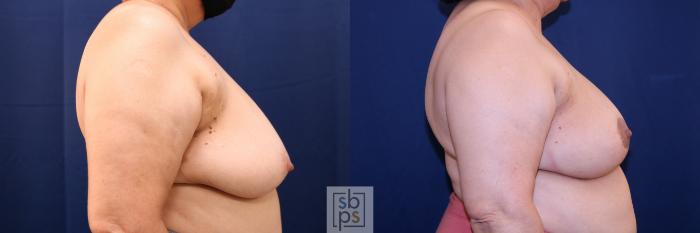 Before & After Breast Reconstruction Case 719 Right Side View in Los Angeles & Torrance, CA, CA