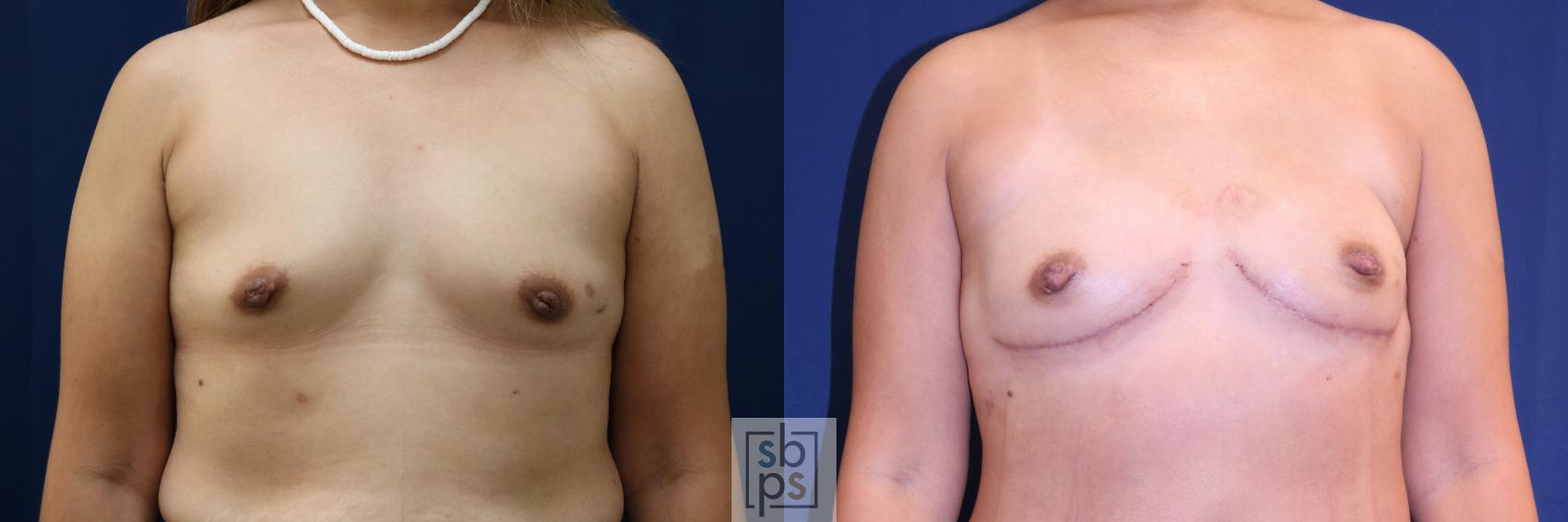 Before & After Breast Reconstruction Case 720 Front View in Los Angeles & Torrance, CA, CA