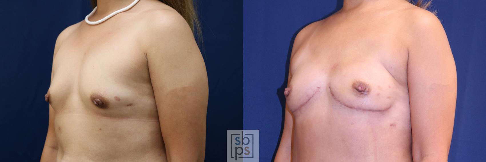 Before & After Breast Reconstruction Case 720 Left Oblique View in Torrance & Los Angeles, CA, CA