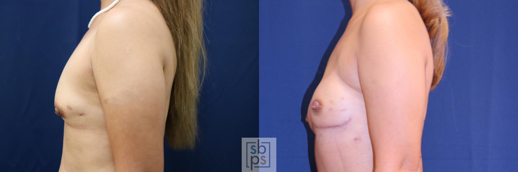Before & After Breast Reconstruction Case 720 Left Side View in Torrance & Los Angeles, CA, CA