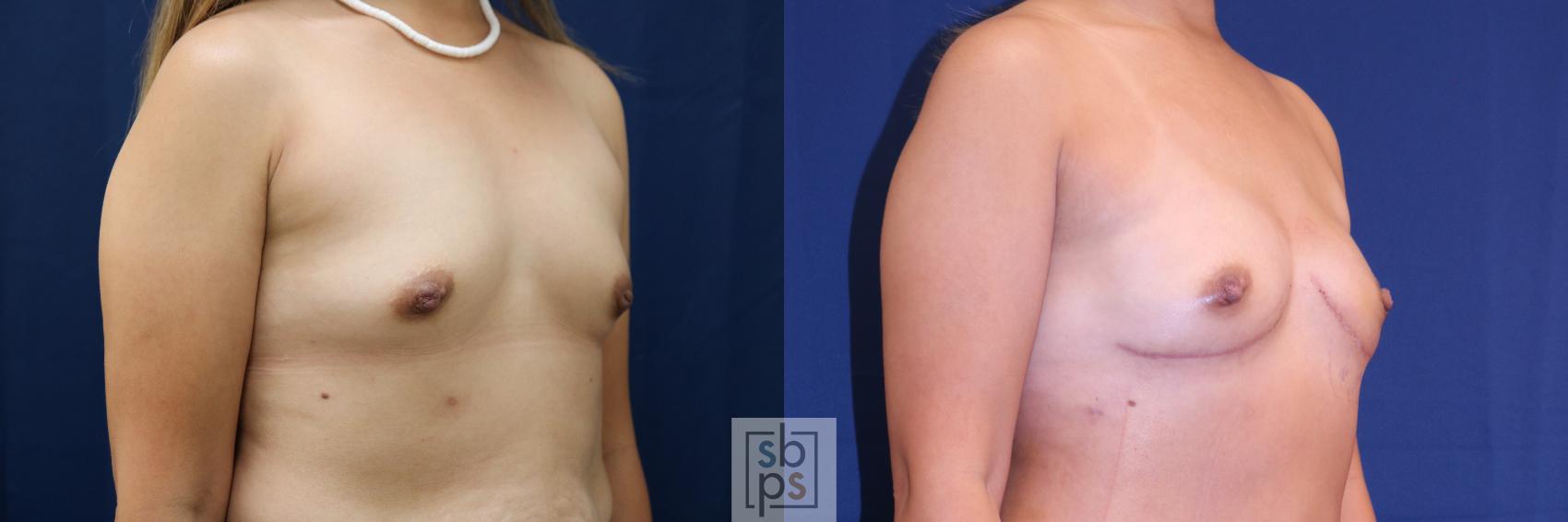 Before & After Breast Reconstruction Case 720 Right Oblique View in Torrance & Los Angeles, CA, CA