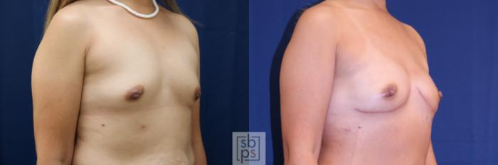 Before & After Breast Reconstruction Case 720 Right Oblique View in Los Angeles & Torrance, CA, CA