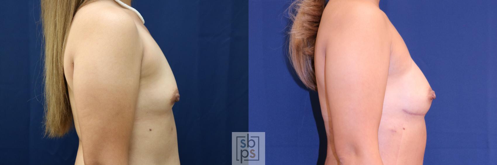 Before & After Breast Reconstruction Case 720 Right Side View in Torrance & Los Angeles, CA, CA