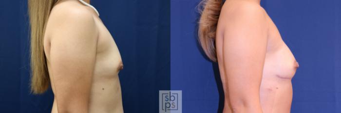 Before & After Breast Reconstruction Case 720 Right Side View in Los Angeles & Torrance, CA, CA