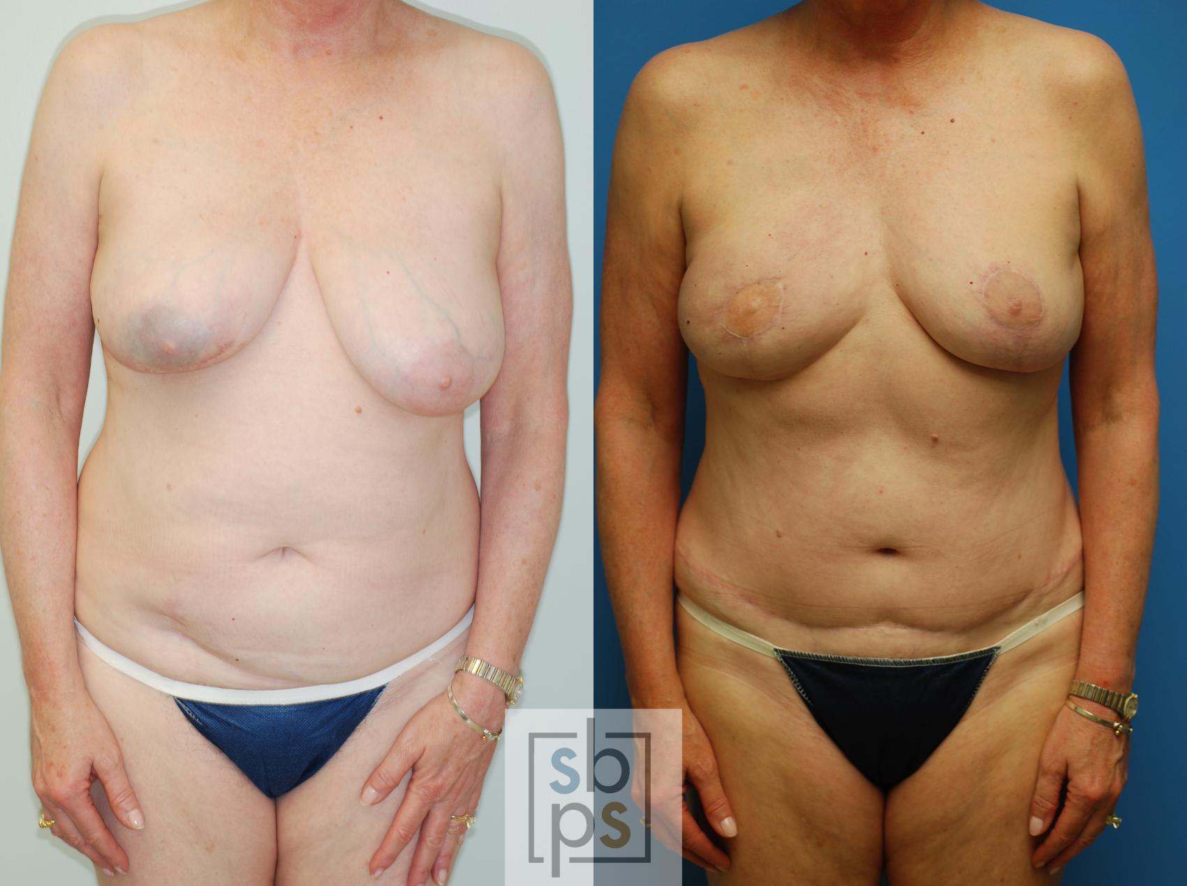 Before & After Breast Reconstruction Case 73 View #1 View in Torrance, CA