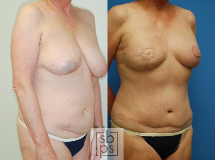 Before & After Breast Reconstruction Case 73 View #2 View in Torrance, CA