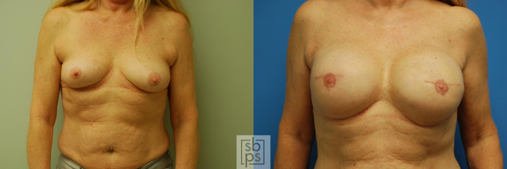 Before & After Breast Reconstruction Case 74 View #1 View in Torrance, CA