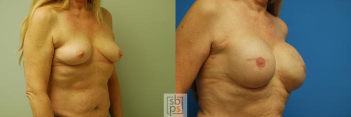 Before & After Breast Reconstruction Case 74 View #2 View in Torrance, CA