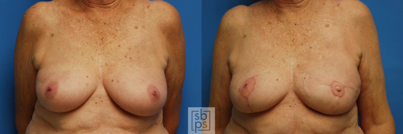 Before & After Breast Reconstruction Case 75 View #1 View in Torrance, CA