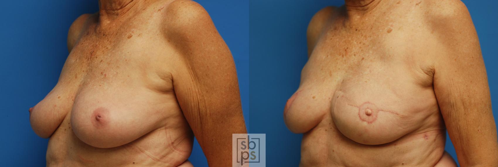 Before & After Breast Reconstruction Case 75 View #2 View in Torrance & Los Angeles, CA, CA