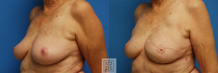 Before & After Breast Reconstruction Case 75 View #2 View in Torrance, CA