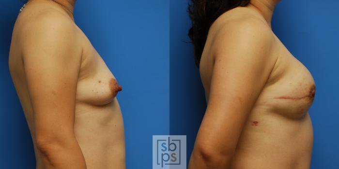 Before & After Breast Reconstruction Case 77 View #2 View in Torrance, CA