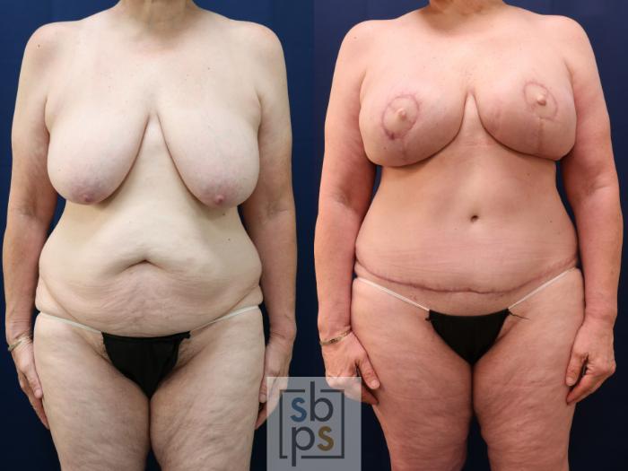 Before & After Breast Reconstruction Case 773 Front View in Los Angeles, Torrance & Long Beach, CA