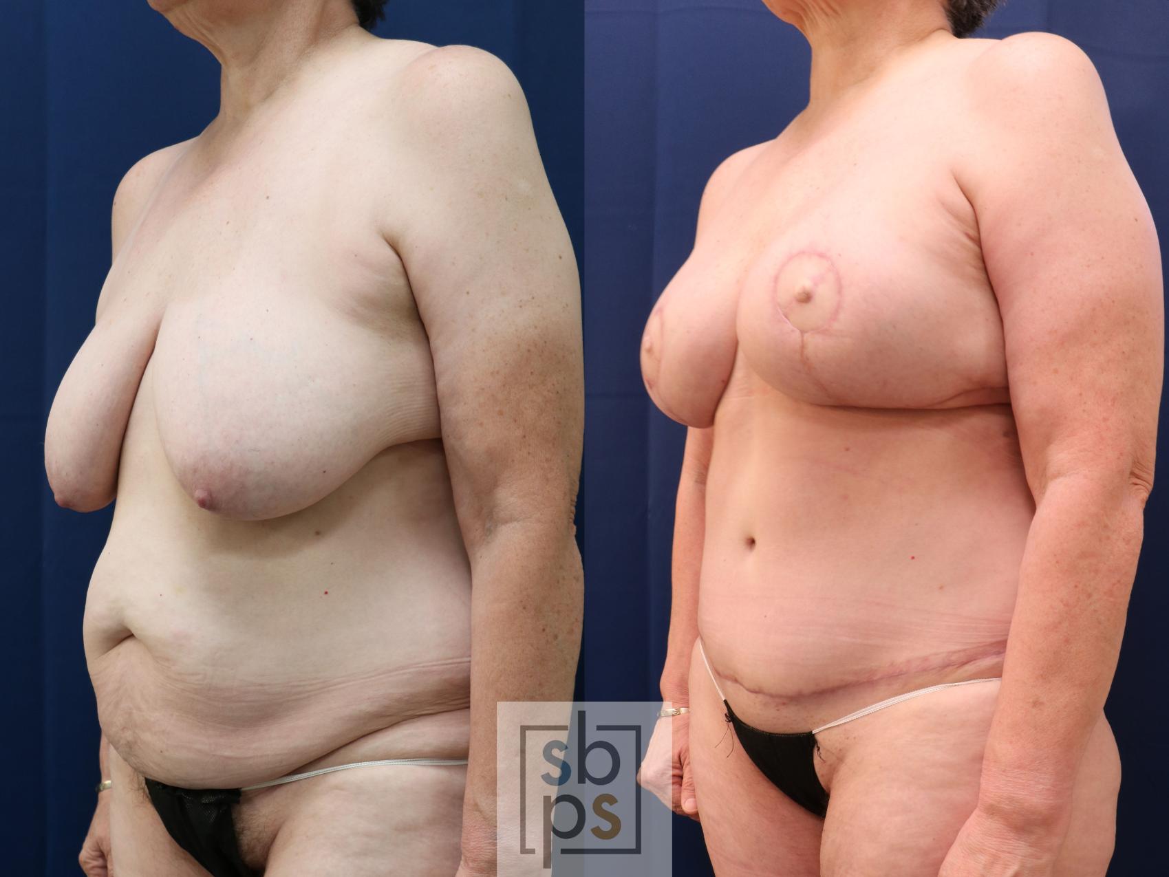 Before & After Breast Reconstruction Case 773 Left Oblique View in Los Angeles, Torrance & Long Beach, CA