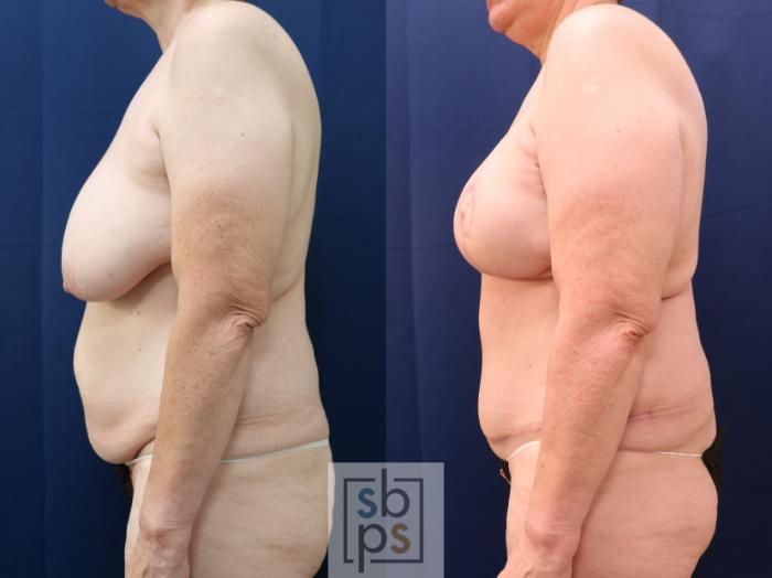 Before & After Breast Reconstruction Case 773 Left Side View in Los Angeles, Torrance & Long Beach, CA
